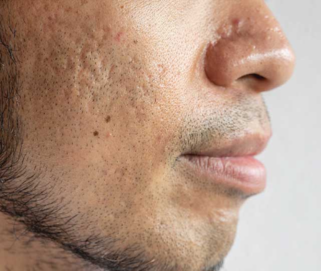 FOR-ACNE-SCARS Microneedling in Phoenix, AZ