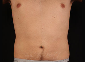 Liposuction Before and After Pictures Phoenix, AZ