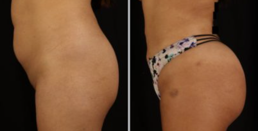 Screen Shot 2022-05-24 at 1.48.00 PM Brazillian Butt Lift