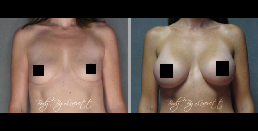 Screen Shot 2022-05-24 at 1.46.07 PM Breast Augmentation