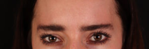 Botox Before and After Pictures Phoenix, AZ
