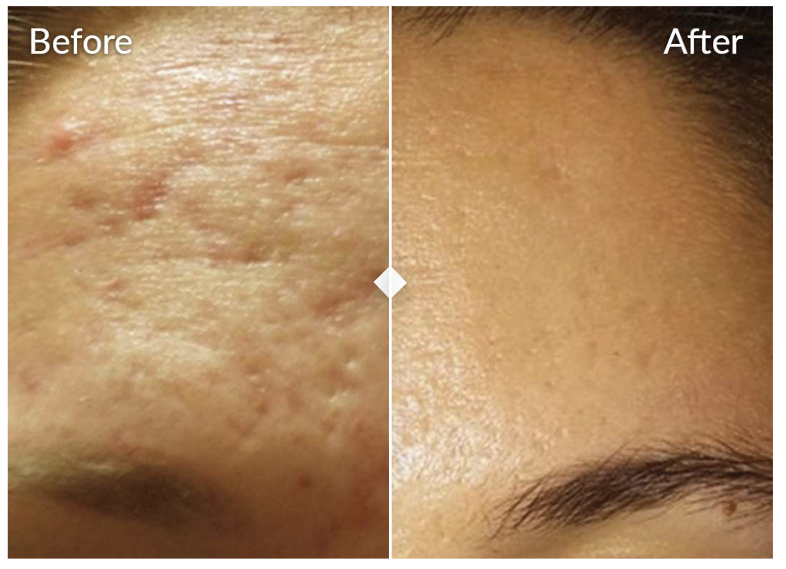 b&a Microneedling in Phoenix, AZ