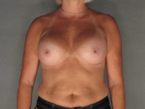 Bilateral Breast Augmentation Before and After Pictures Phoenix, AZ