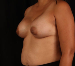 Breast Augmentation Before and After Pictures Phoenix, AZ