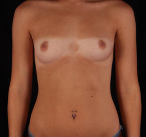 Bilateral Breast Augmentation Before and After Pictures Phoenix, AZ