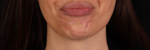 Botox Before and After Pictures Phoenix, AZ