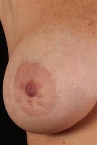 Inverted Nipple Before and After Pictures Phoenix, AZ