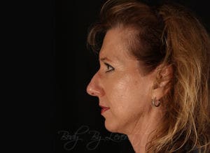 Facelift Before and After Pictures Phoenix, AZ