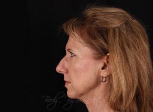 Facelift Before and After Pictures Phoenix, AZ