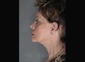 Body by Leverett Before and After Images