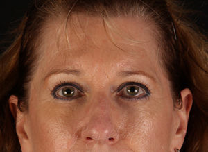 Brow Lift Before and After Pictures Phoenix, AZ