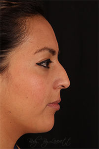 Rhinoplasty Before and After Pictures Phoenix, AZ