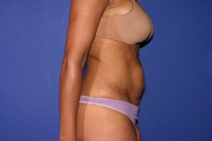 Tummy Tuck Before and After Pictures Phoenix, AZ