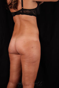 Tummy Tuck Before & After Pictures in Phoenix, AZ